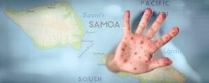 Samoan Measles Outbreak